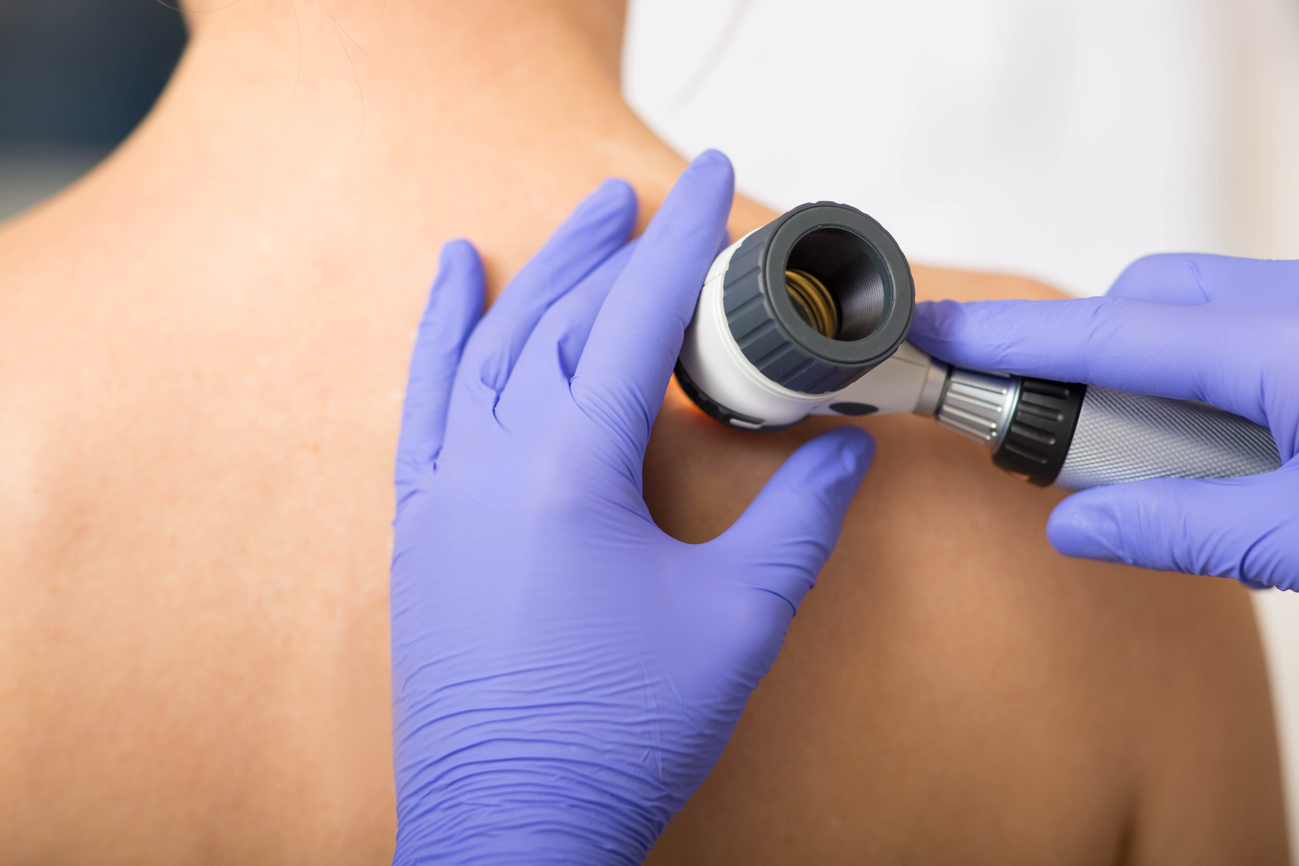 Doctor Examining Patient Skin Moles